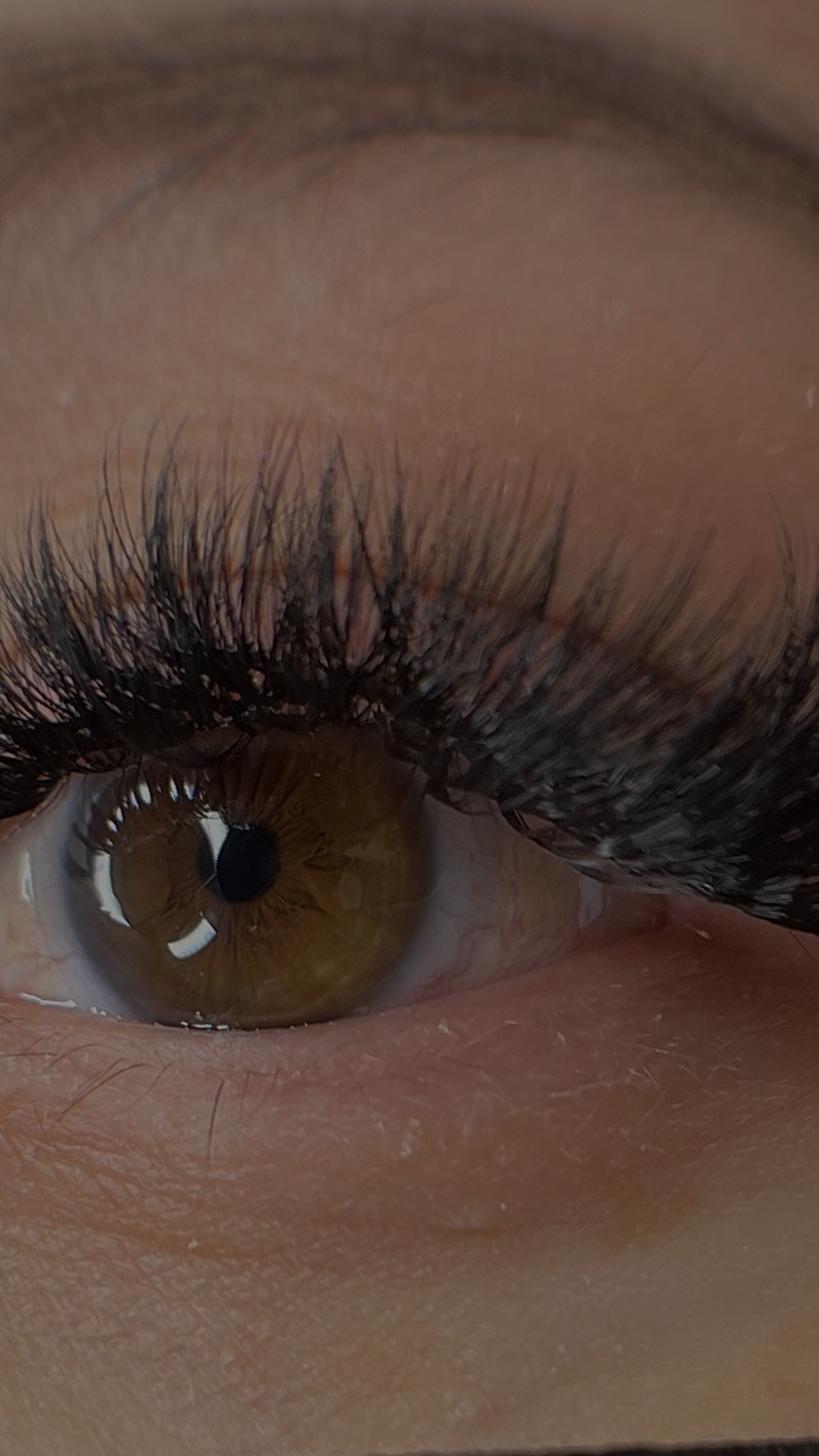 Lash Extensions and Dermatitis